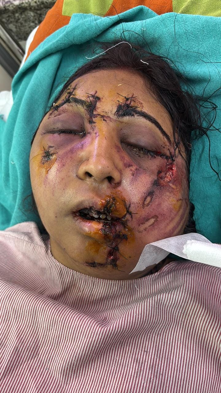 दिल्ली में दहेज उत्पीड़न का क्रूर मामला: दो बहनों पर ससुराल वालों ने किया जानलेवा हमला, अस्पताल में भर्ती